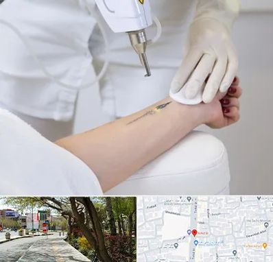 پاک کردن تتو با لیزر در خیابان توحید اصفهان