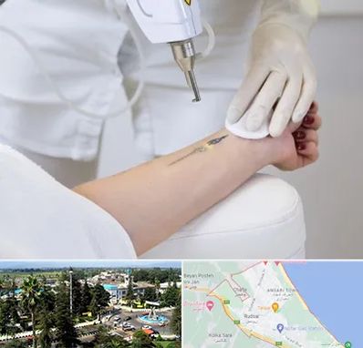 پاک کردن تتو با لیزر در رودسر