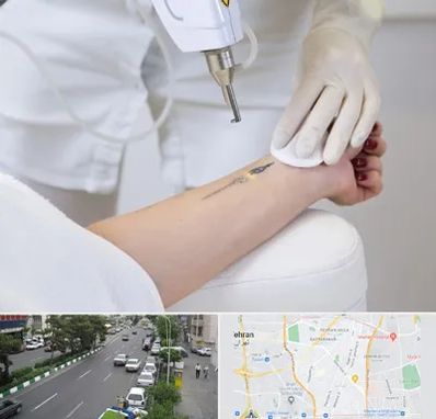 پاک کردن تتو با لیزر در ستارخان