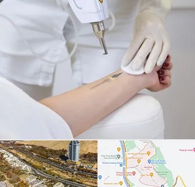 پاک کردن تتو با لیزر در خیابان نیایش شیراز