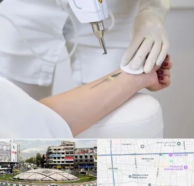 پاک کردن تتو با لیزر در مرکز تهران