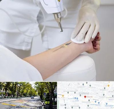 پاک کردن تتو با لیزر در میرداماد