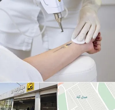 پاک کردن تتو با لیزر در عبدل آباد