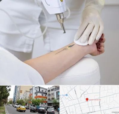 پاک کردن تتو با لیزر در هفده شهریور تبریز