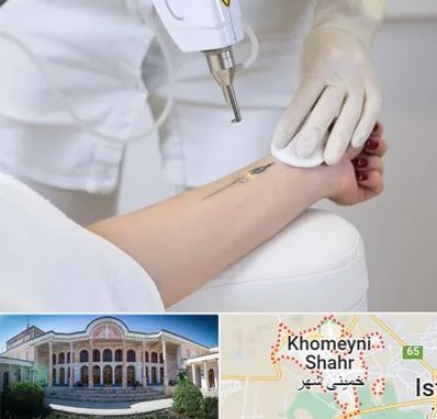 پاک کردن تتو با لیزر در خمینی شهر