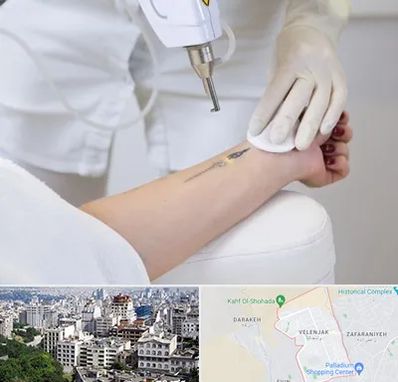 پاک کردن تتو با لیزر در ولنجک