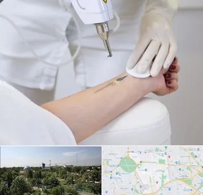 پاک کردن تتو با لیزر در منطقه 16 تهران