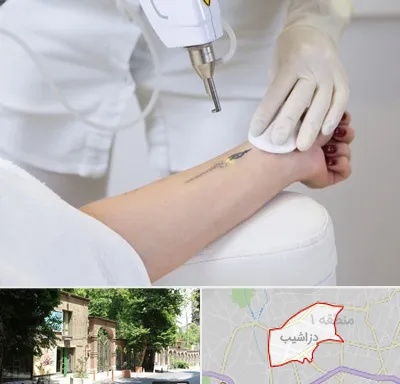پاک کردن تتو با لیزر در دزاشیب