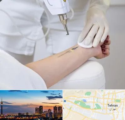 پاک کردن تتو با لیزر در غرب تهران تهران