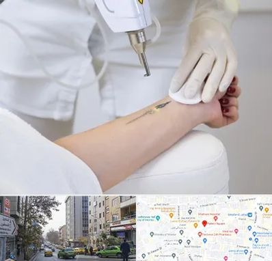 پاک کردن تتو با لیزر در فاطمی