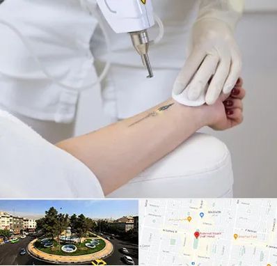 پاک کردن تتو با لیزر در هفت حوض