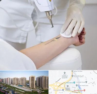 پاک کردن تتو با لیزر در المپیک