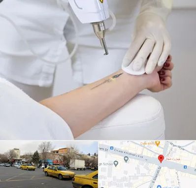 پاک کردن تتو با لیزر در شهناز تبریز