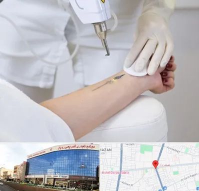 پاک کردن تتو با لیزر در نصف راه تبریز