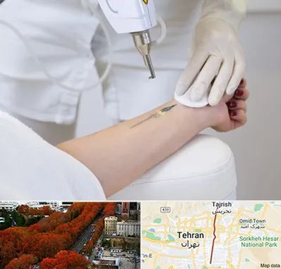 پاک کردن تتو با لیزر در ولیعصر