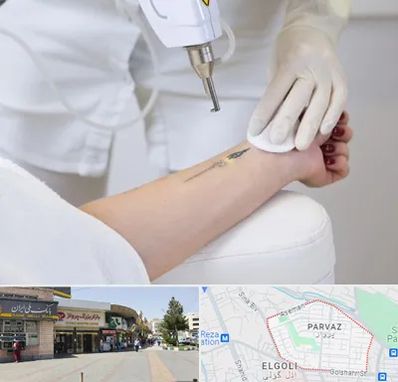 پاک کردن تتو با لیزر در پرواز تبریز