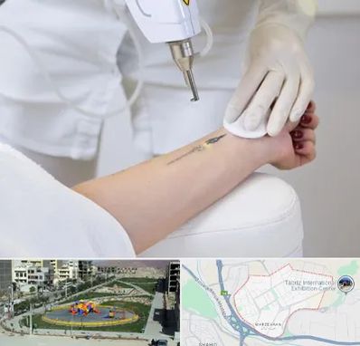 پاک کردن تتو با لیزر در مرزداران تبریز