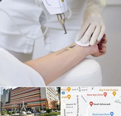 پاک کردن تتو با لیزر در سهروردی