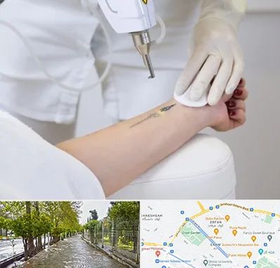 پاک کردن تتو با لیزر در خیابان ارم شیراز