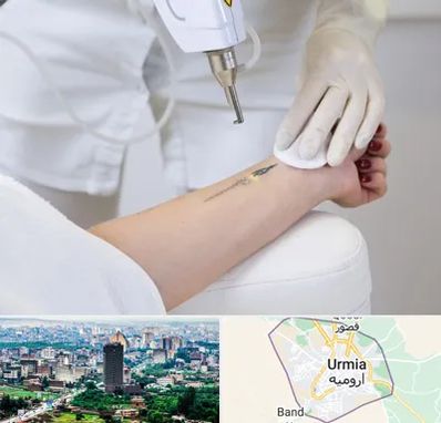 پاک کردن تتو با لیزر در ارومیه