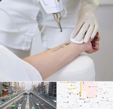 پاک کردن تتو با لیزر در توحید