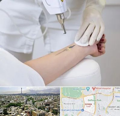 پاک کردن تتو با لیزر در گیشا