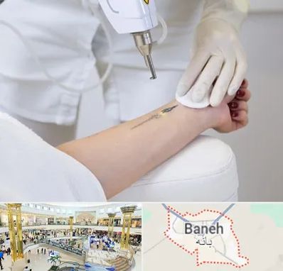 پاک کردن تتو با لیزر در بانه