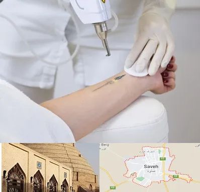 پاک کردن تتو با لیزر در ساوه