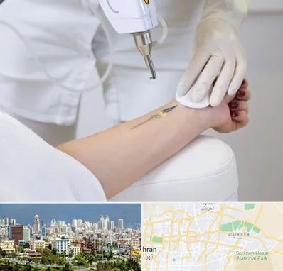 پاک کردن تتو با لیزر در شرق تهران تهران