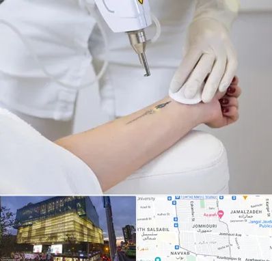 پاک کردن تتو با لیزر در جمهوری