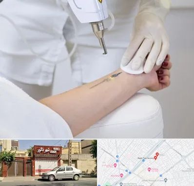 پاک کردن تتو با لیزر در باجک قم