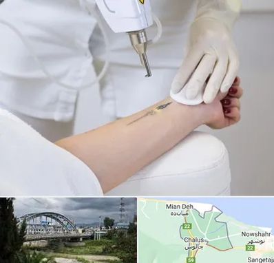 پاک کردن تتو با لیزر در چالوس