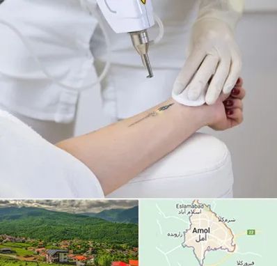 پاک کردن تتو با لیزر در آمل