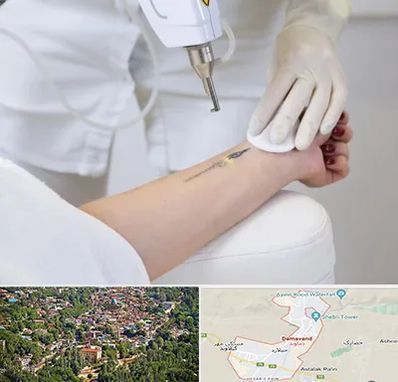 پاک کردن تتو با لیزر در دماوند