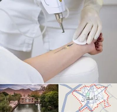 پاک کردن تتو با لیزر در دامغان