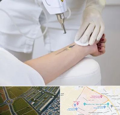 پاک کردن تتو با لیزر در الهیه مشهد