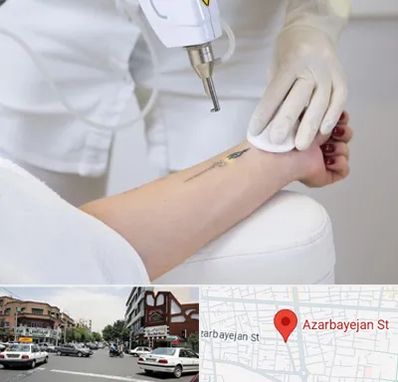 پاک کردن تتو با لیزر در خیابان آذربایجان