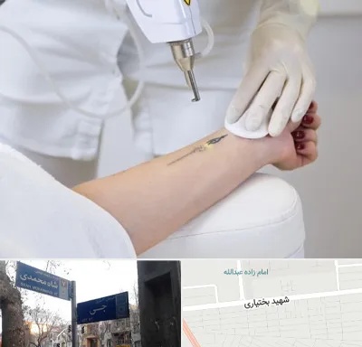 پاک کردن تتو با لیزر در سی متری جی