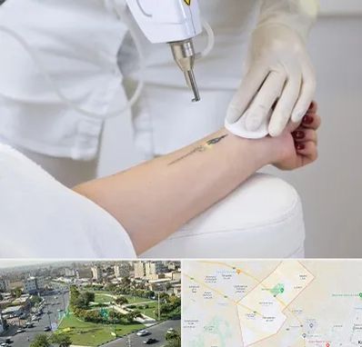 پاک کردن تتو با لیزر در کمال شهر کرج