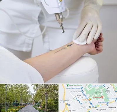 پاک کردن تتو با لیزر در قدوسی غربی شیراز