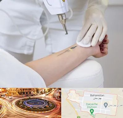 پاک کردن تتو با لیزر در بهارستان