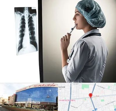 دکتر سرطان ریه در نصف راه تبریز