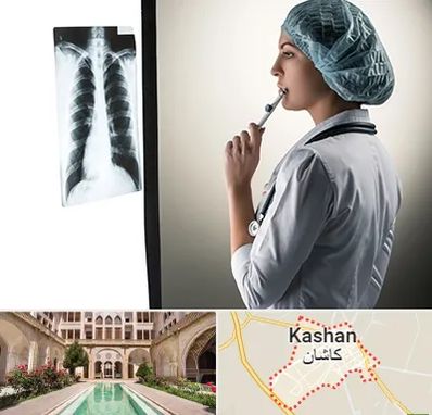 دکتر سرطان ریه در کاشان