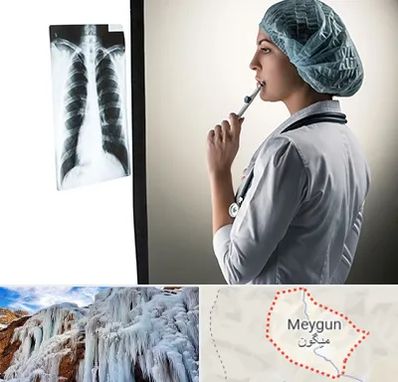 دکتر سرطان ریه در میگون