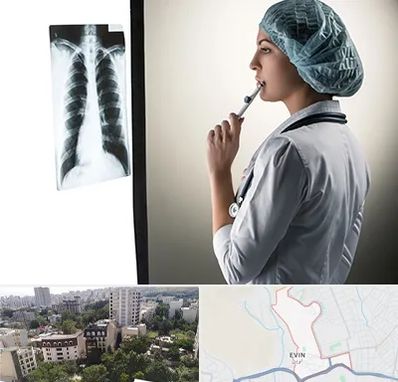 دکتر سرطان ریه در اوین