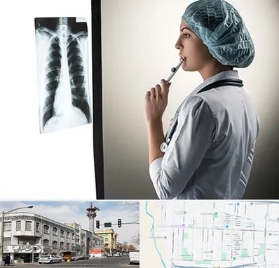 دکتر سرطان ریه در 17شهریور