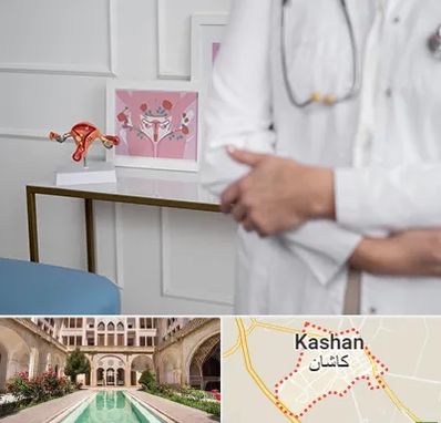 دکتر سرطان تخمدان در کاشان