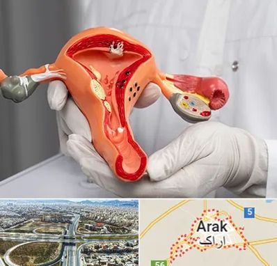 دکتر سرطان رحم در اراک