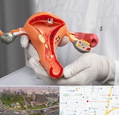 دکتر سرطان رحم در آیت الله کاشانی 