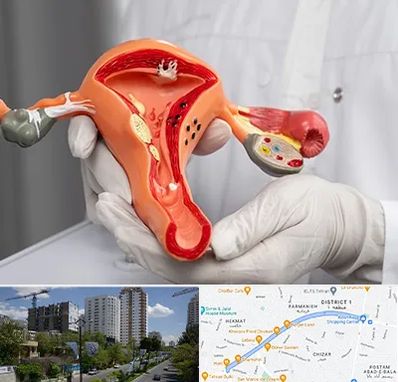 دکتر سرطان رحم در اندرزگو 